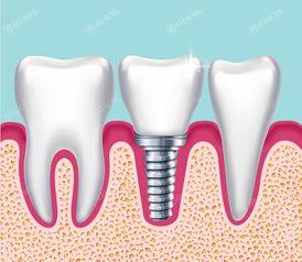贵阳排名前十的种植牙医院名单已公布，均是正规靠谱的牙科