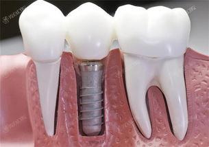 长春技术好的种植牙医院排名前十,看长春哪家种植牙好技术靠谱