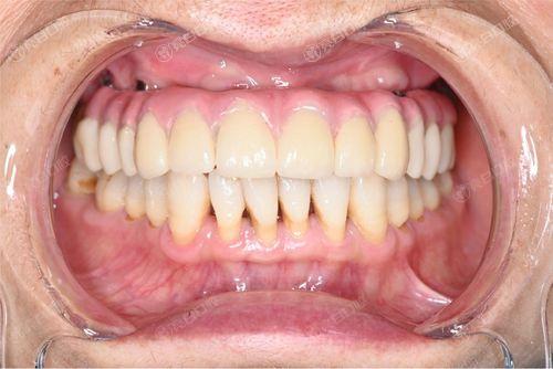 杭州公私立十大口腔医院2024年排名公布!均是当地好评价牙科种植牙技术强