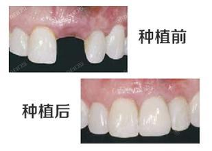 杭州公私立十大口腔医院2024年排名公布!均是当地好评价牙科种植牙技术强