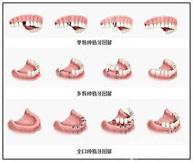 广州种植牙医院排名前十榜单，广州服务好的牙科医院正规靠谱