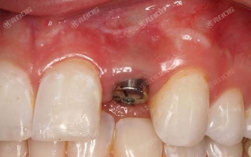 太原种植牙哪家医院技术好？2024年太原种植牙评分前十的口腔医院公布