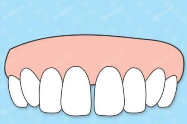 门牙缝隙大（1）.jpg