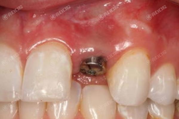 西安门牙种牙十大口腔连锁品牌！曝2024年西安种植牙排行前十的口腔医院