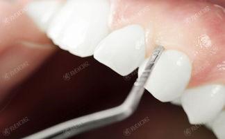 安排同进口腔佳德店口腔项目收费标准公开 洗牙100+烤瓷牙300+牙周治疗5000+