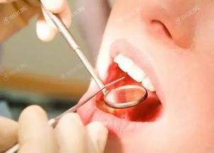 全新东莞口腔医院拔牙收费标准公开 阻生牙拔除术/智齿拔除/无痛拔牙没想象的贵