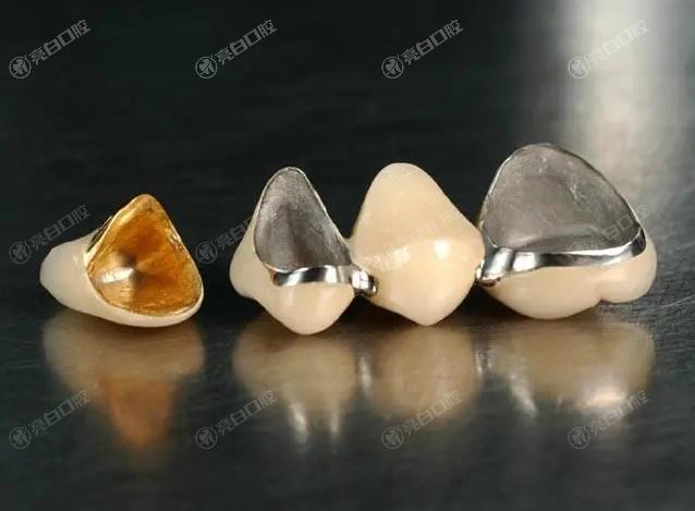 不同材质的牙冠