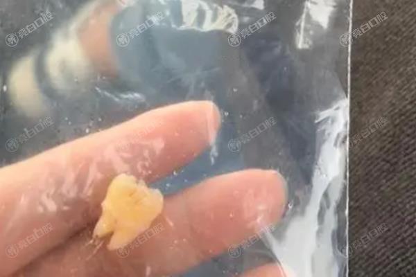医院拔智齿多少钱