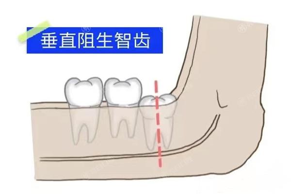 垂直阻生智齿
