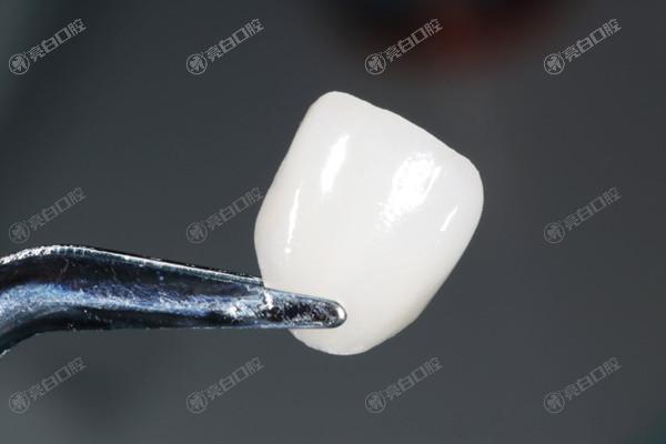 牙齿贴面