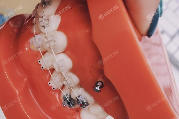 北京冠美口腔医院牙齿矫正价格表