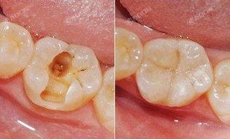 上海补牙齿到哪个医院好？这四大口腔医院靠谱价格好