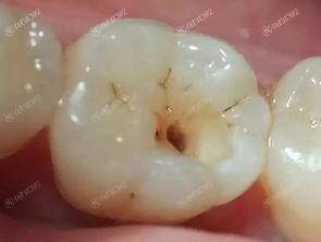 成都补牙齿哪家医院好？靠谱口碑好的四大牙科医院投递