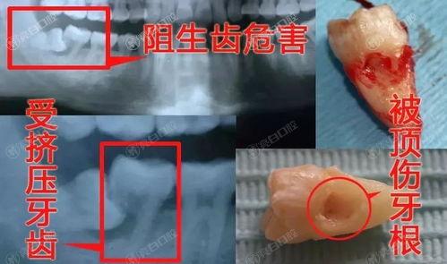 深圳补牙齿哪家医院价格好？2025补牙齿价格前八的口腔医院揭秘