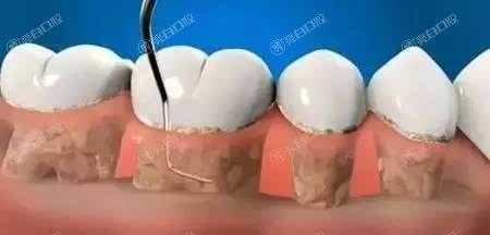 天津智齿到哪个医院好？这三大口腔医院靠谱价格好
