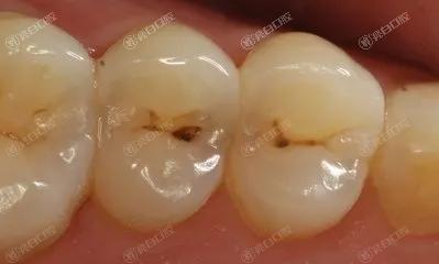 厦门根管治疗哪家医院服务好？曝2025年厦门根管治疗排行前三的口腔医院