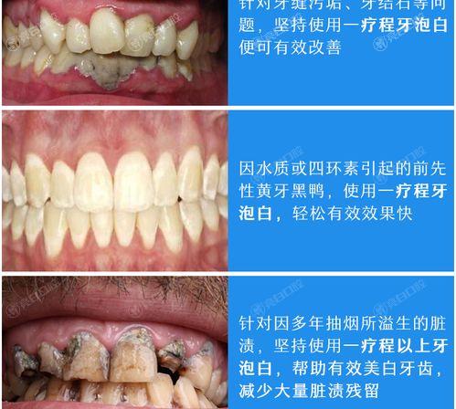 曝2025年北京洗牙上榜清单前六的口腔医院，看牙齿都比较好