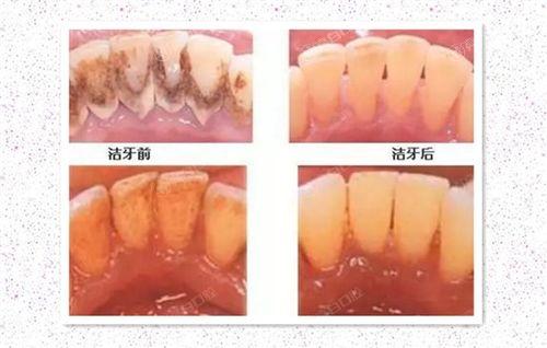 北京洗牙到哪个医院好？这六大口腔医院靠谱口碑好