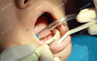 北京洗牙哪家医院价格好？2024年北京洗牙评分前六的口腔医院公布
