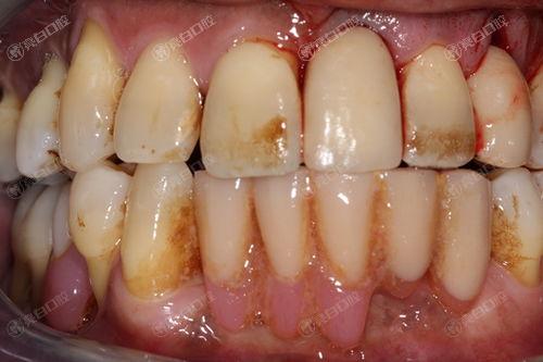 北京洗牙到哪个医院好？这六大口腔医院靠谱口碑好