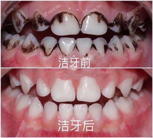 北京服务好的六大口腔医院排名，洗牙技术好服务靠谱的是这六家