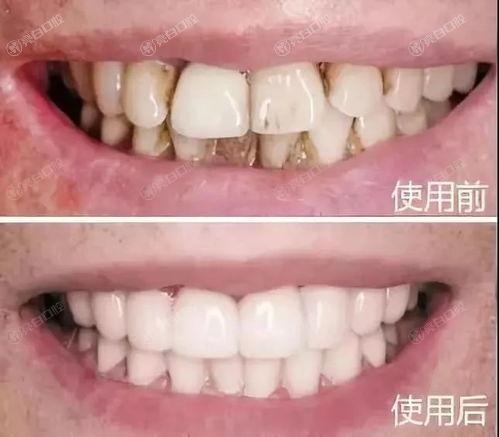 深圳洗牙哪个医院好？评分高价格靠谱的洗牙排名榜找到了