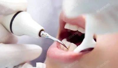 北京洗牙哪个医院好？评分高价格靠谱的洗牙排名榜找到了