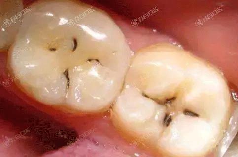 北京洗牙哪家医院好？曝靠谱实力好的洗牙前六口腔医院