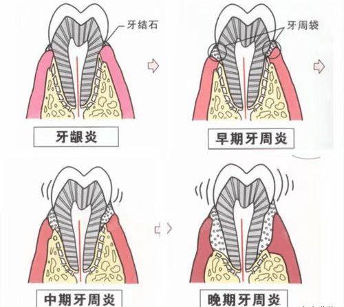 想知道上海牙周治疗价钱贵不，上海牙周治疗价格果然不贵！