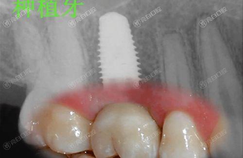 南通排名前六的种植牙医院名单已公布，均是正规靠谱的牙科