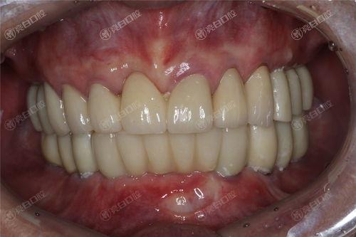 南通排名前六的种植牙医院名单已公布，均是正规靠谱的牙科