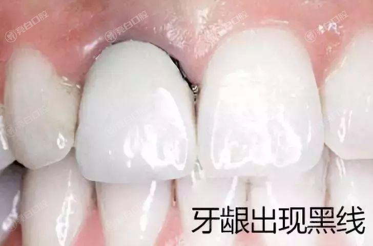 宁波烤瓷牙纳入医保了吗？2025宁波烤瓷牙技术好的医院排名曝光