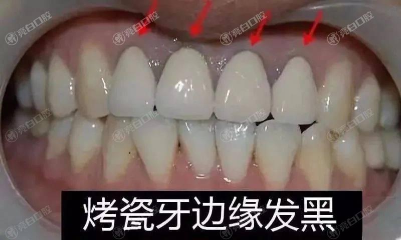 赣州烤瓷牙哪家医院好?安利排名前四的正规价格好的口腔医院