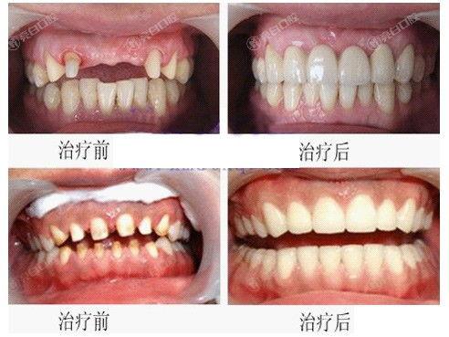 宁波烤瓷牙哪家医院价格好？揭秘2025年宁波烤瓷牙排名前八的口腔医院