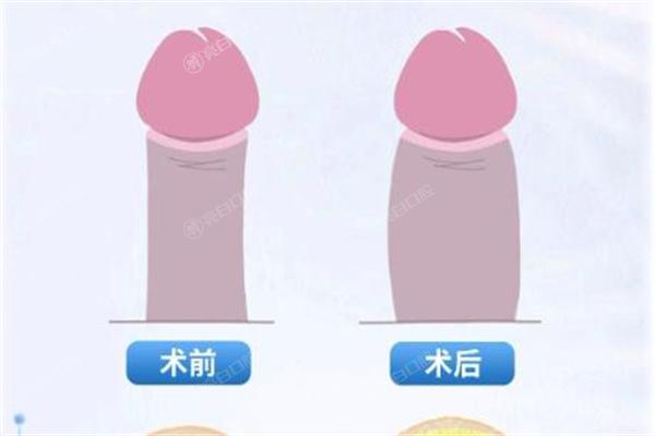 国内做男性私密整形技术好的医院精心推荐:男科延长增粗|假体植入|阴茎镶珠手术就选这几家放心