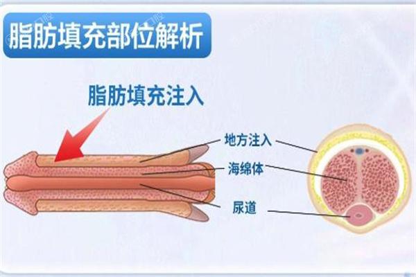 国内做男性私密整形技术好的医院精心推荐:男科延长增粗|假体植入|阴茎镶珠手术就选这几家放心
