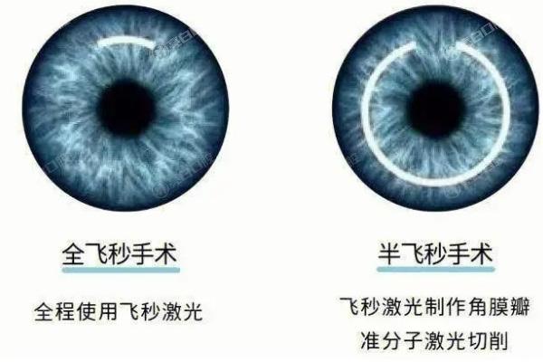 郑州近视手术价格一览表2025：含半飞秒|全飞秒|晶体近视价格