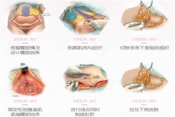 李湘源腹部拉皮手术怎么样？技术好可参考李湘源腹部拉皮手术实例