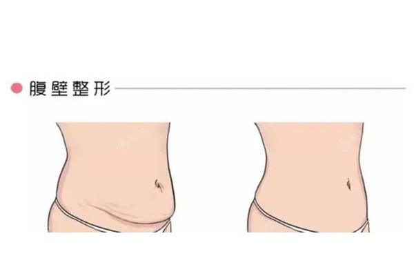 李湘源腹部拉皮手术怎么样？技术好可参考李湘源腹部拉皮手术实例