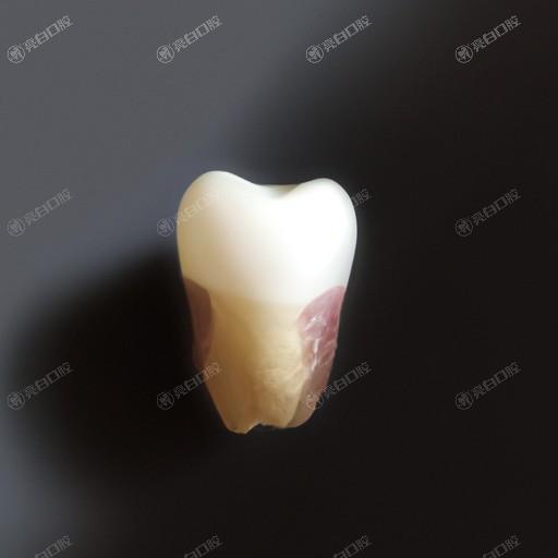 全烤瓷牙价格及优缺点详解，让你了解齐全的牙齿修复方案