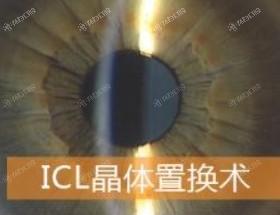 速览石家庄眼科医院近视眼手术收费贵吗 在眼科医院做EVO晶体植入30800