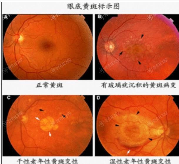 来看看北京眼科医院白内障手术要多少钱 其中双焦点晶体16800元+|非球面折叠晶体15300元+|单焦点晶体15900元+