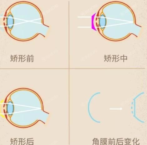 新版佛山眼科医院青光眼手术价格一览表 做/挺便宜