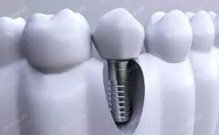 做瑞典诺贝尔种植牙过程需要多久?一次性告诉你完整流程