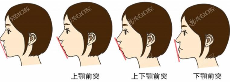 广州下颌角整形比较好的医院 get便宜又好的几家分享大家
