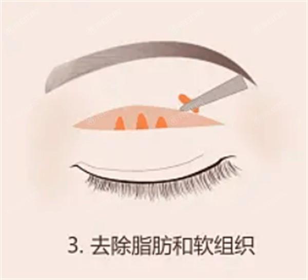 济南去雀斑哪个医院好？ 排名前7里诺德/丽合/爱容挺出名