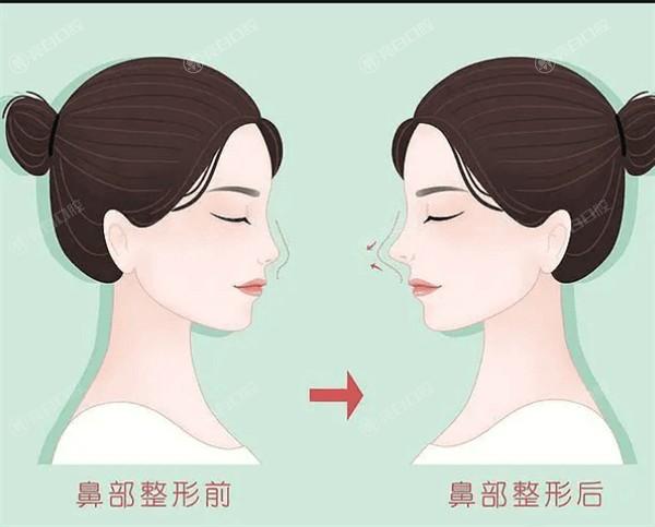 福州舒颜玻尿酸哪家正规又靠谱？ 格莱美/美贝尔/福州爱美尔整形技术牛口碑好