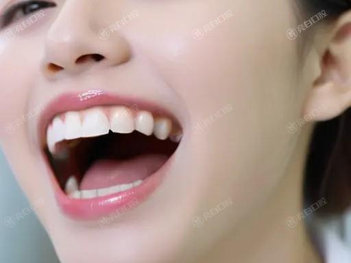 做欧睛自锁托槽后，是否可以放心进行剧烈运动？